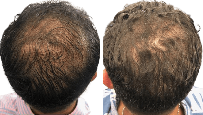 PRF_HairLoss1a_11_19_21-removebg-preview